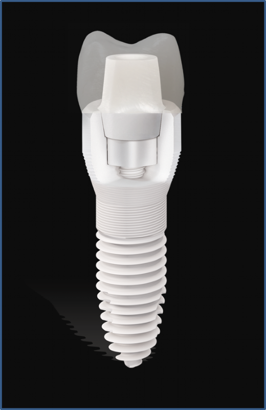 Vollkeramikimplantat in Graz